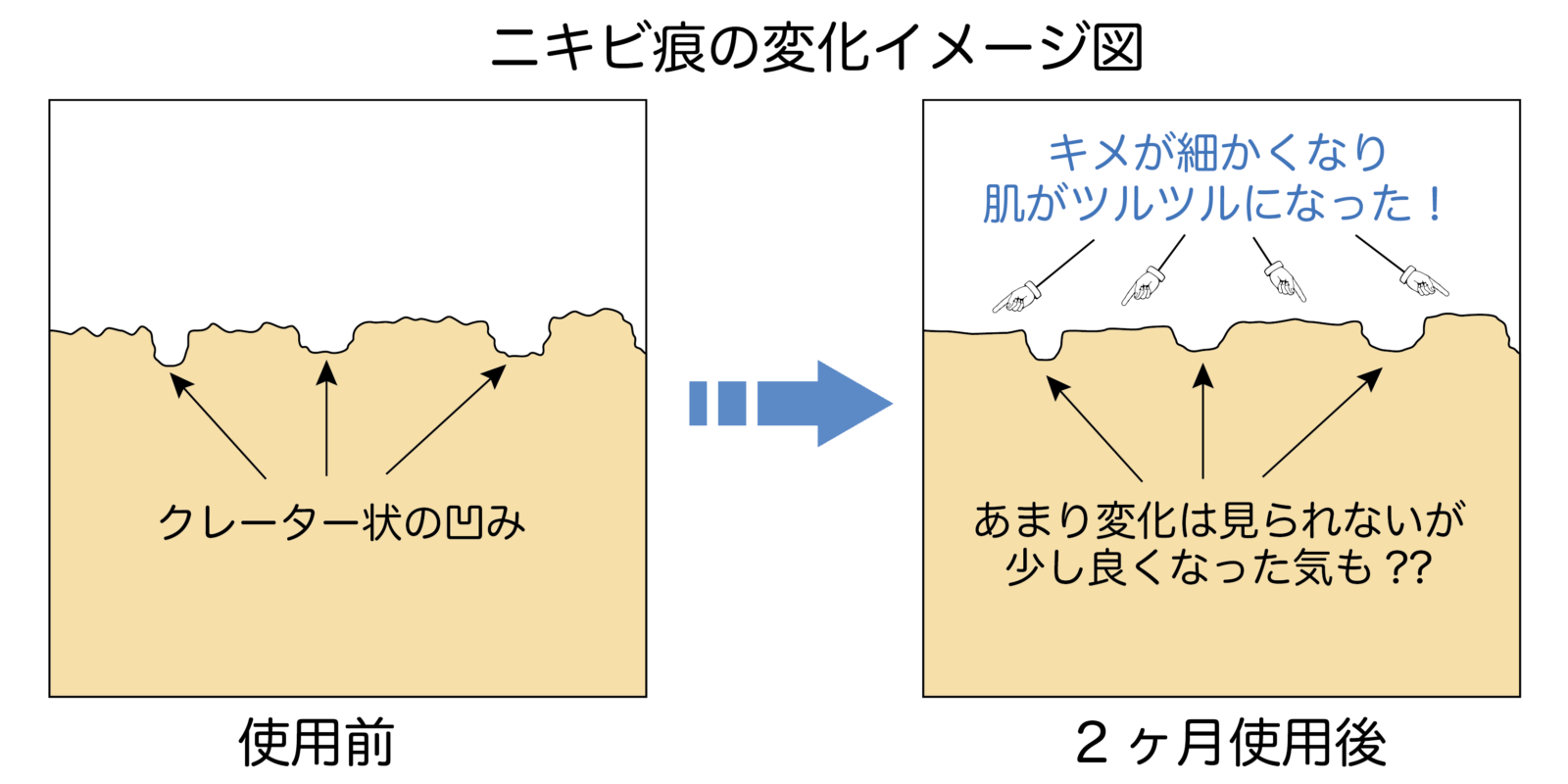 ニキビ痕の変化イメージ図