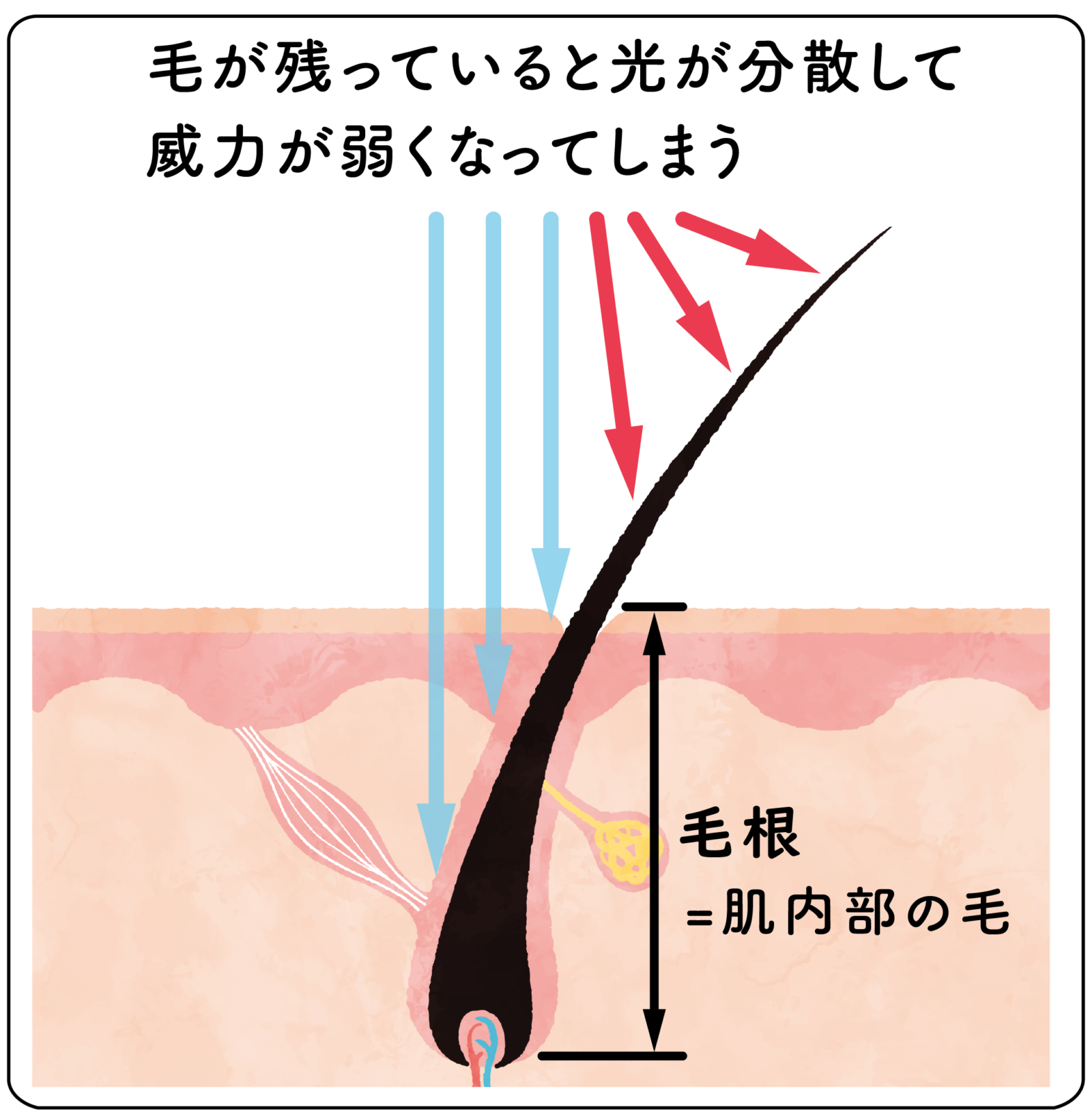 脱毛前のシェービング