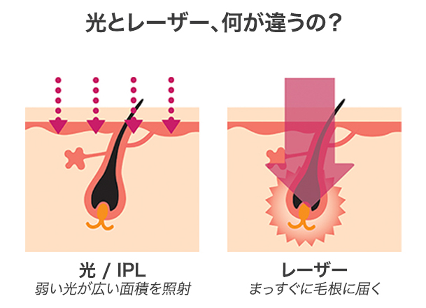 レーザー脱毛と光脱毛の違い1