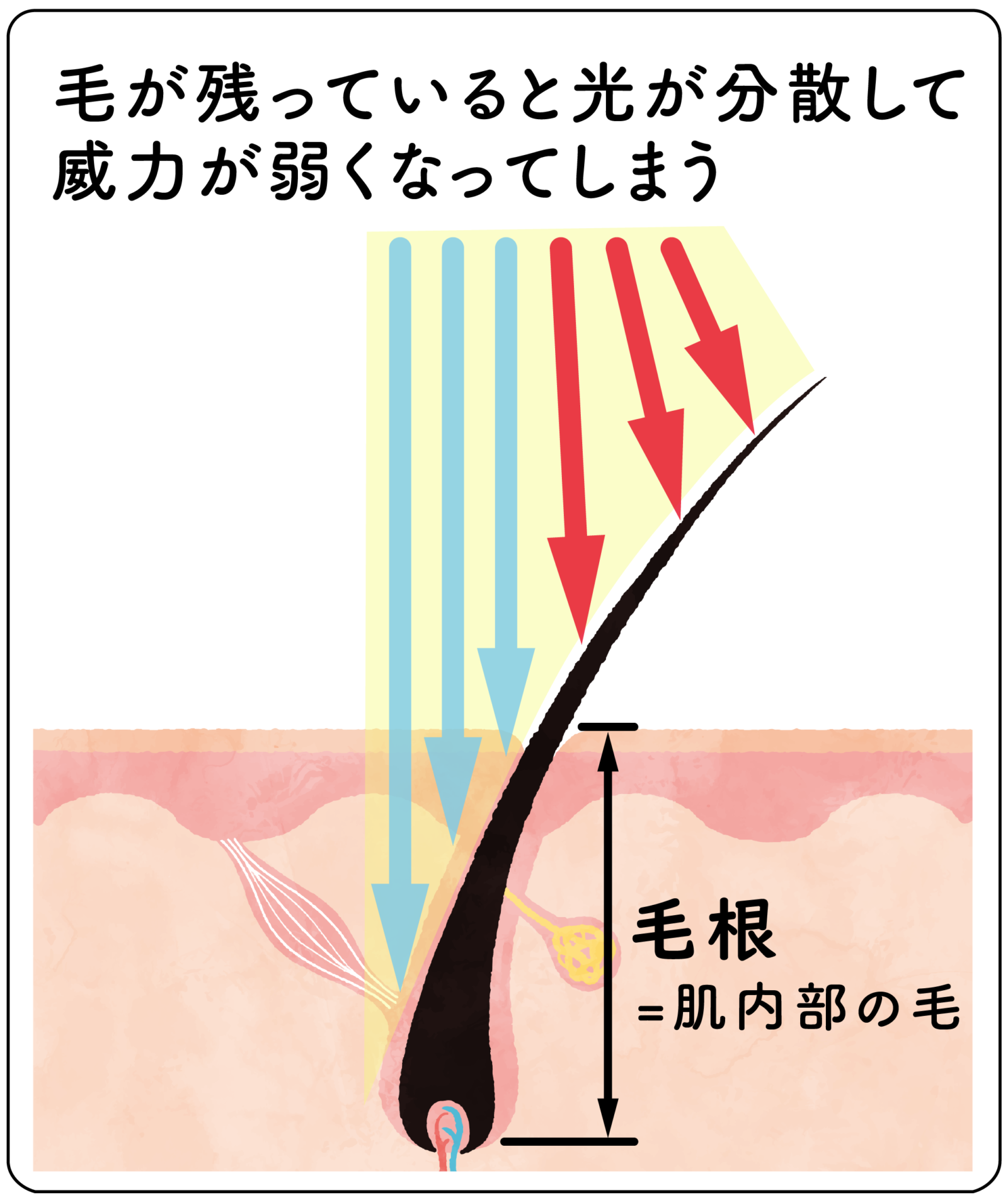 脱毛前のシェービング