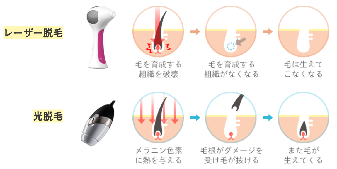 レーザー脱毛と光脱毛の違い2