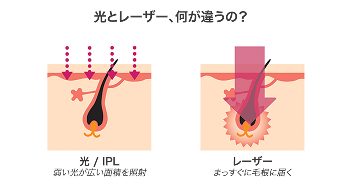 レーザー脱毛と光脱毛の違い